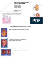 Microscopic and Macroscopic of Renal Cell Carcinoma