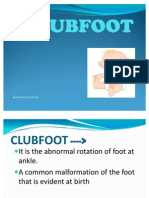 Clubfoot