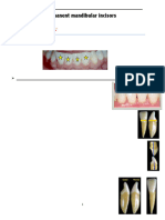 Mandibular Incisors