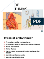 4a. Types of Arrhythmias