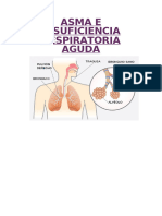 Caso Clinico Asma e Insuficiencia