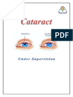 Cataract