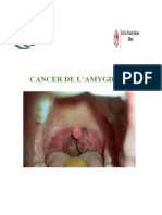 Cancer de lamygdale