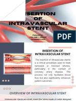 INSERTION OF INTRAVASCULAR STENT-(TARNATE, LYKA JANE & UCHI, CATHERINE) 