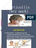 Torticollis Wry Neck