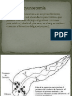 Pancreatoyeyunostomia