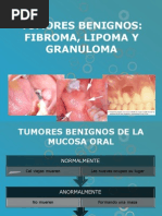 Lipoma, Granuloma, Fibroma