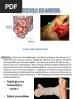 Diverticulo de Meckel