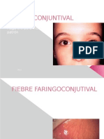 Fiebre Faringoconjuntival