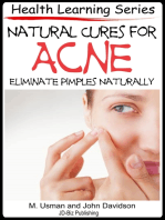 Natural Cures for Acne