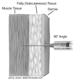 tekening van intramusculaire injectie