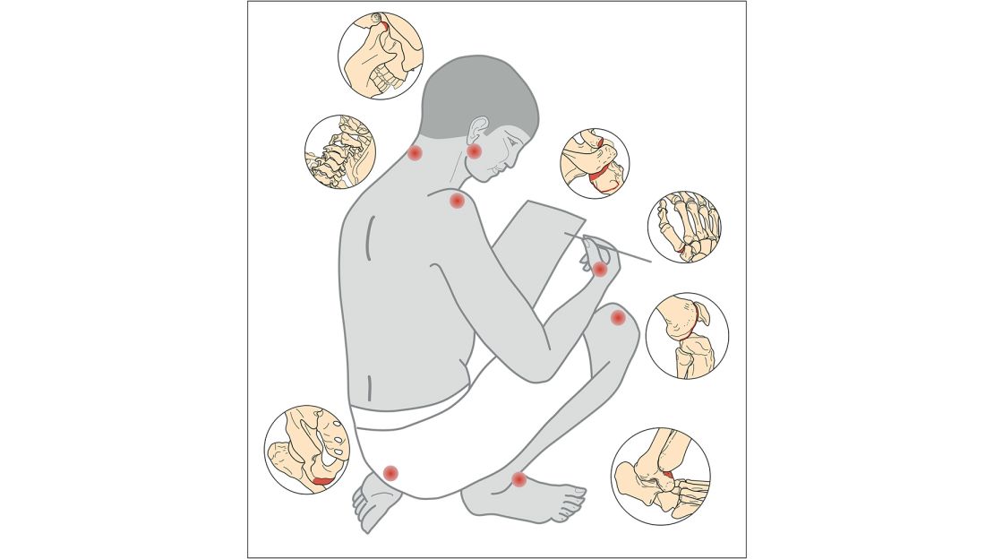 A drawing shows the parts of the skeleton most affected by the sitting positions and work carried out by scribes.