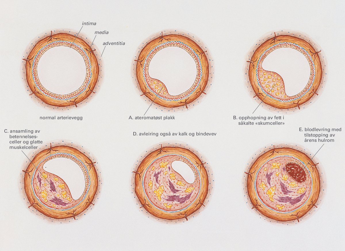 Aterosklerose.