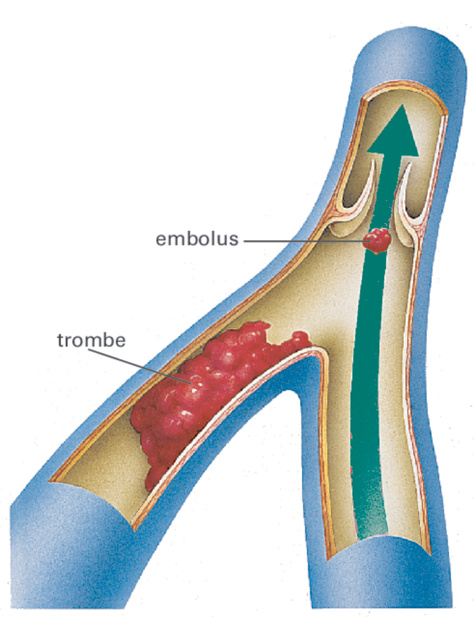 Embolisme