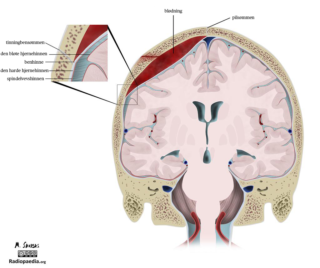 Epiduralt hematom