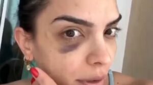 Natinha mostra hematoma causado por procedimento estético - Crédito: 