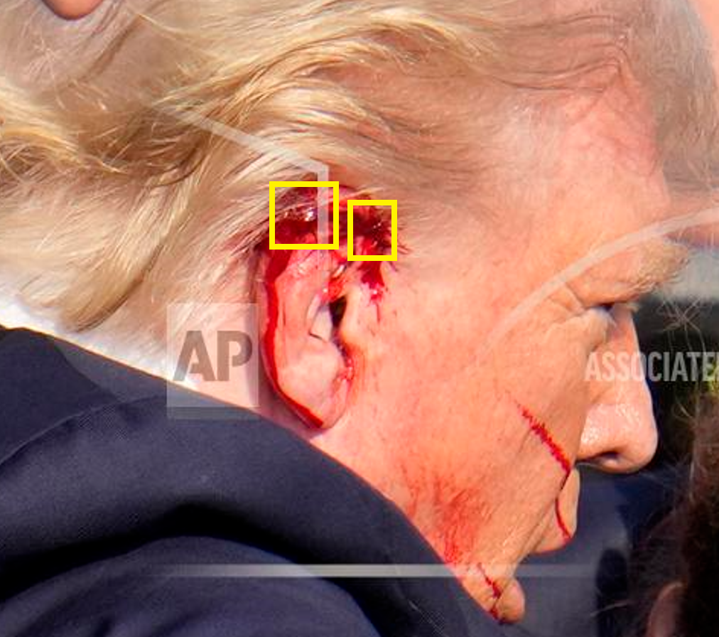 In this photo of Trump’s ear, you can see two wounds that seem to line up with the path of the bullet. Our team added the yellow boxes to highlight the two wounds.