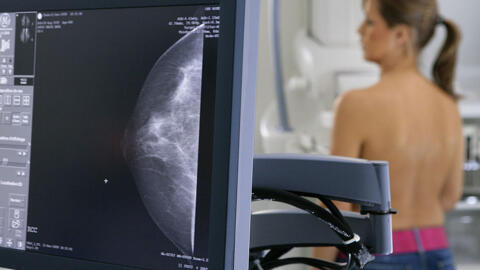 La investigación abarcó el seguimiento de casi 6 mil mujeres con cáncer de mama precoz y sin metástasis. 