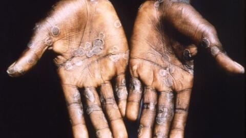 Mpox can cause fevers, headaches, and muscle aches, as well as painful boils on the skin.