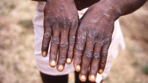 A dangerous new strain of mpox is spreading quickly along the eastern border of the DRC, scientists have warned. 