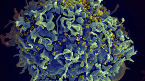 تصویر میکروسکوپ الکترونی از یک سلول انسان (به رنگ آبی)، که مورد حمله ویروس اچ‌آی‌وی (به رنگ زرد) قرار گرفته است.