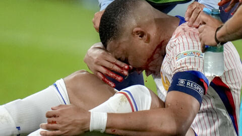 France skipper Kylian Mbappé injured his nose during his side's opening Group D game against Austria at the European championships in Germany.