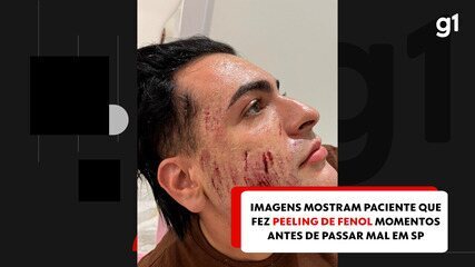 Imagens mostram paciente que fez peeling de fenol momentos antes de passar mal em SP