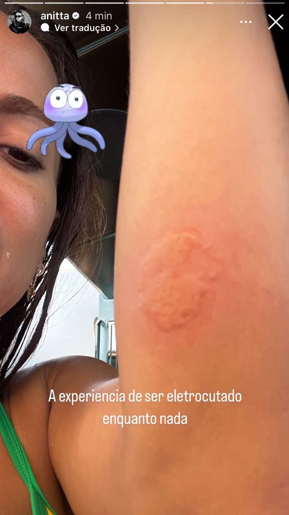 Anitta é queimada por água-viva — Foto: Instagram