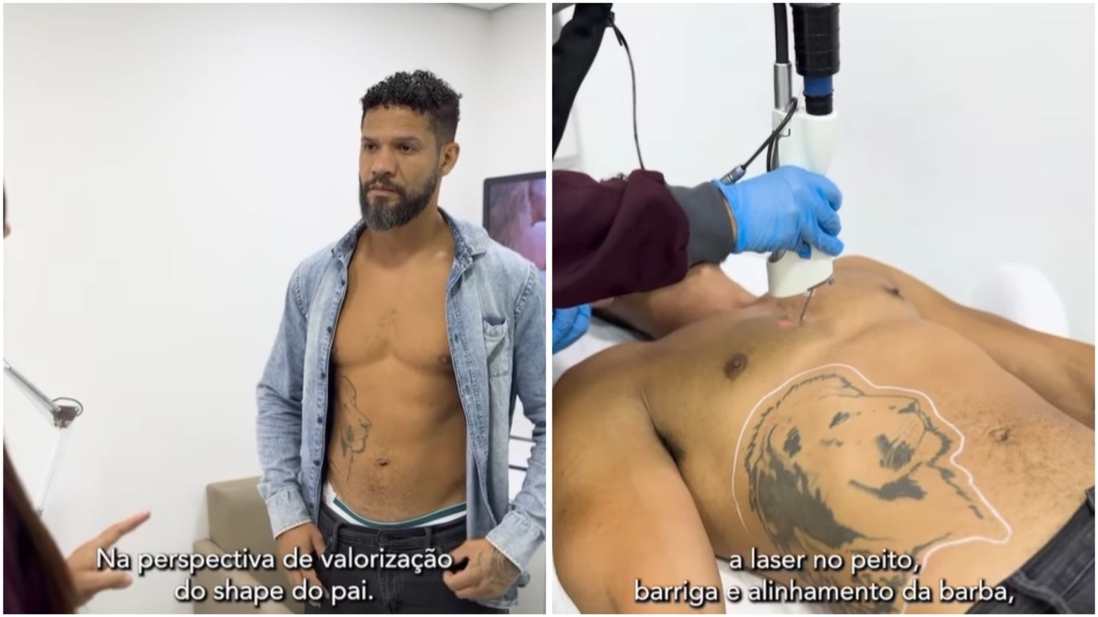 Juninho também apostou nos procedimentos estéticos. Ele fez laser no peito e na barriga e alinhamento da barba