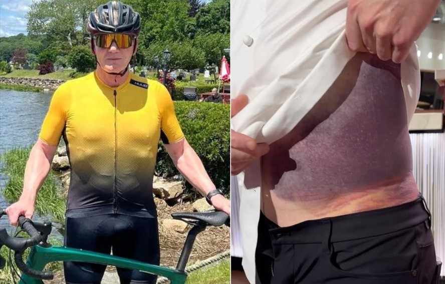 Gordon Ramsay mostra hematoma após acidente de bicicleta
