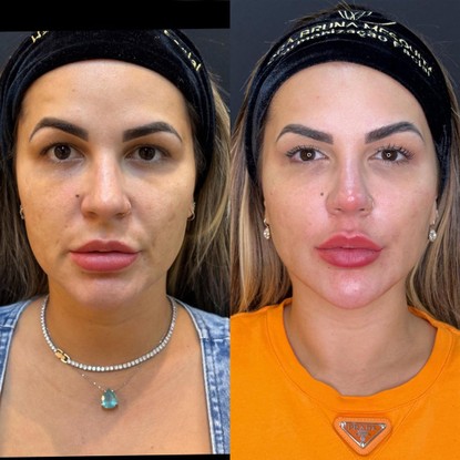 O antes e depois de Deolane Bezerra