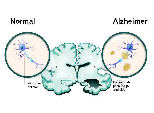 Na doença de Alzheimer, observa-se o surgimento de placas senis decorrentes do depósito de proteína β-amiloide.