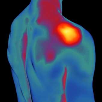 Imagen térmica del cuerpo destaca una región que contiene puntos gatillo comunes