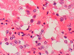 Adenovirus infection Case 161 (5443933536).jpg