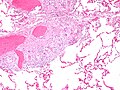 显微镜下显示出肺内结节病性肉芽肿，包含星状小体，使用HE染色