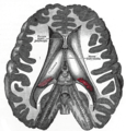 Przekrój poprzeczny mózgu pokazujący komory mózgu.
