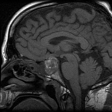 MRI of man with pituitary apoplexy
