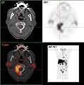 Métastases ostéolytiques dans la deuxième vertèbre du cou (Axis) d'un cancer de la prostate.