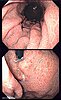 Stomach of a patient with portal hypertensive gastropathy