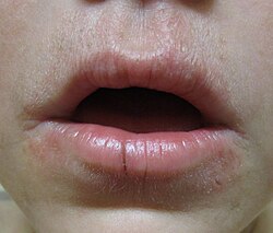 فم شاب مصاب بالتهاب الجلد حول الفم.