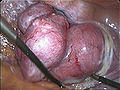 Herausziehen (Extraktion) der Gebärmutter über die Scheide bei der totalen laparoskopischen Hysterektomie (TLH)