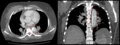 Pembedahan aorta (jenis B Stanford) dengan imbasan CT dada menurun (bulatan merah)