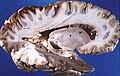 ヒトの脳の左側を切開して取り除き、外側面から見た図。