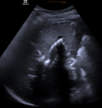 Abdomensonographie bei einer Patientin mit low phospholipid associated cholelithiasis (LPAC).