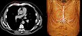 Musculus sternalis seen at axial CT and volume rendering.