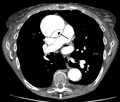 CT dengan kontras menunjukkan pembedahan aorta menaik dan dilatasi aneurisma (jenis A Stanford)