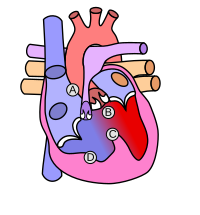 A ağciyər arteriyasının daralması B aortanın sağ vəziyyəti- dekstrapozisiyası C Mədəciklərarası çəpərin qüsuru D sağ mədəciyin hipertrofiyası və ya əzələsinin qalınlaşması