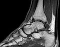 MRT des Sprunggelenks in T1-Wichtung
