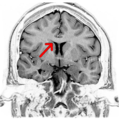 MRI snimak mozga na razini kaudatnog jezgra i corpus callosum