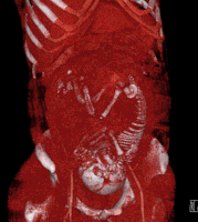 Volume rendered CT scan of a pregnancy